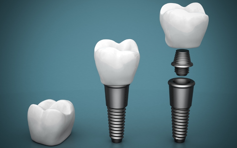 How To Protect Your Dental Implants During High-Impact Activities